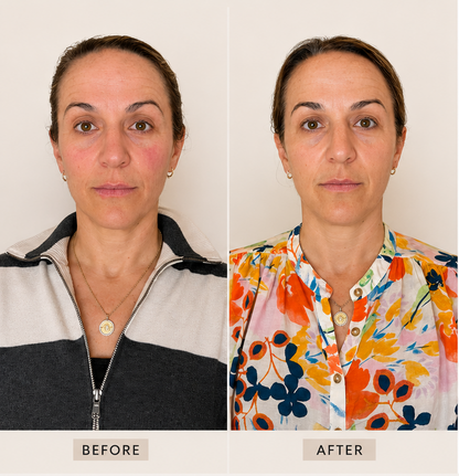 Before and After 42 year old woman